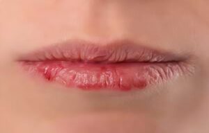 cheilitis